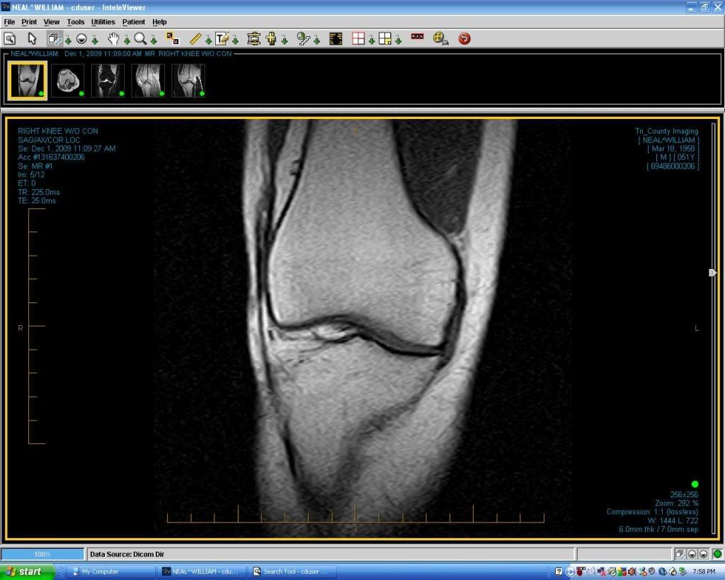 torn lcl mri